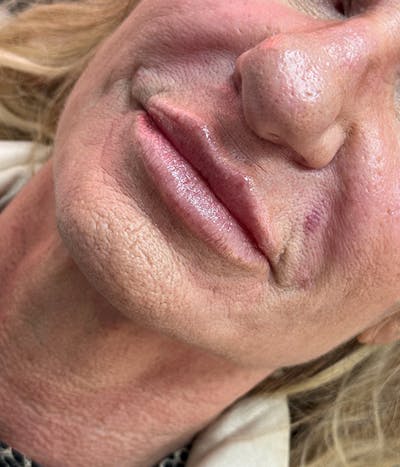 Dermal Fillers Before & After Gallery - Patient 610876 - Image 2