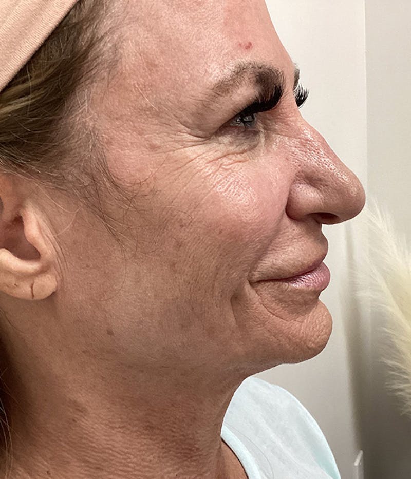 Microneedling Before & After Gallery - Patient 103482 - Image 1