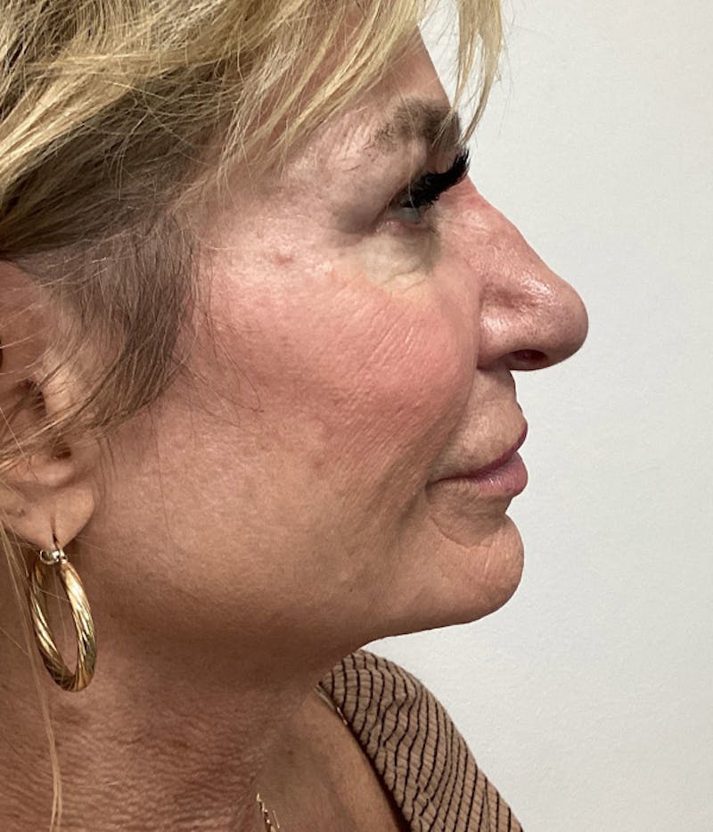 Microneedling Before & After Gallery - Patient 103482 - Image 2