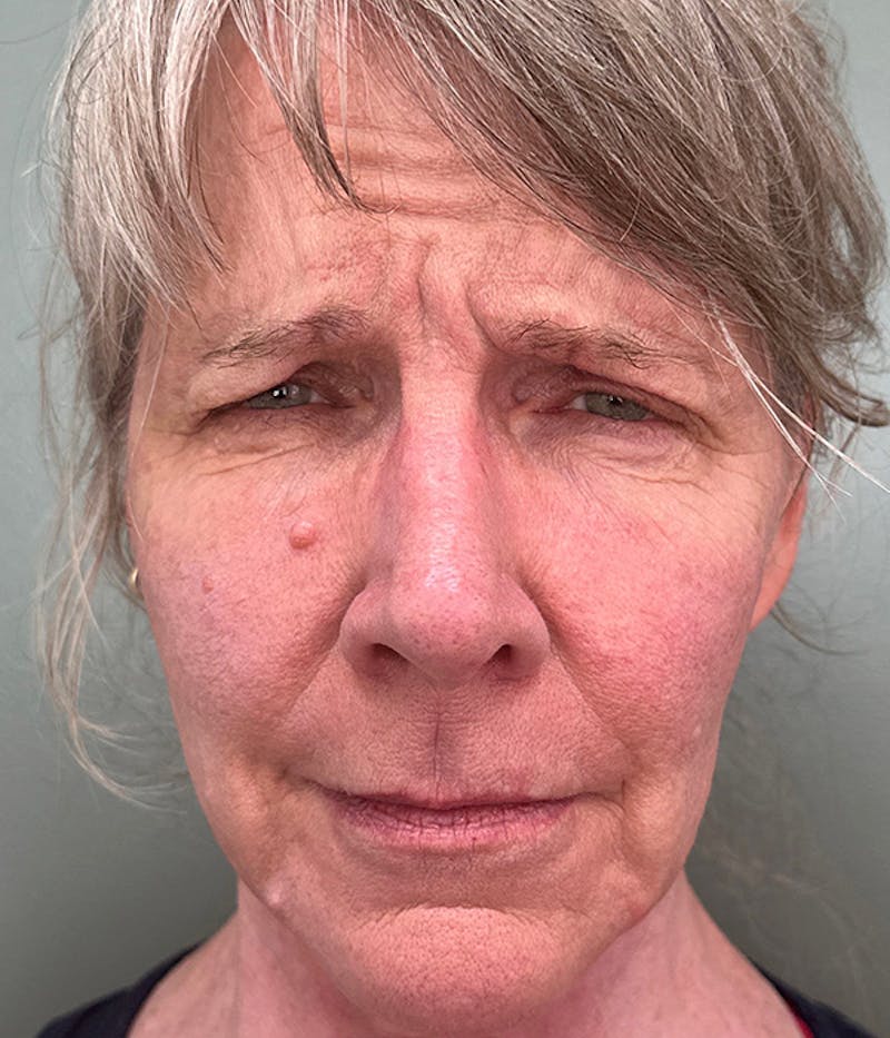 BOTOX Before & After Gallery - Patient 337659 - Image 1