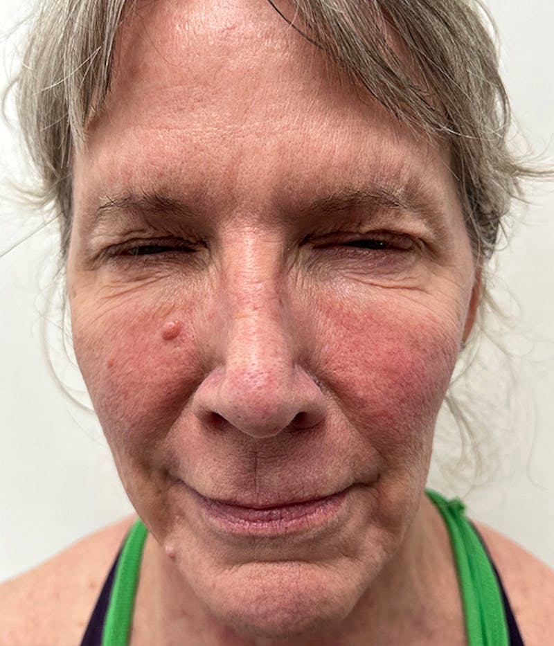 BOTOX Before & After Gallery - Patient 337659 - Image 2