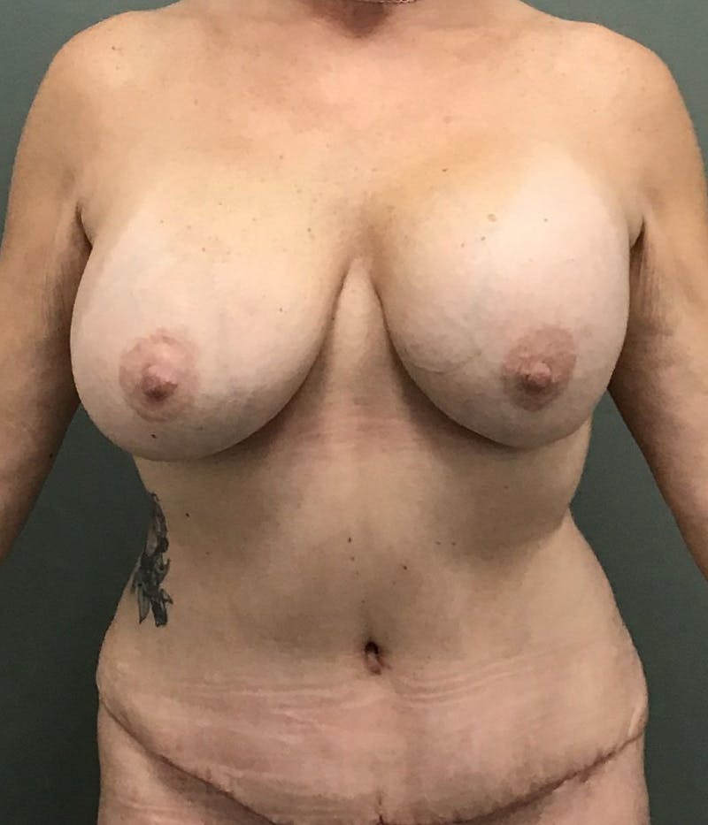 Breast Augmentation Before & After Gallery - Patient 109244 - Image 2