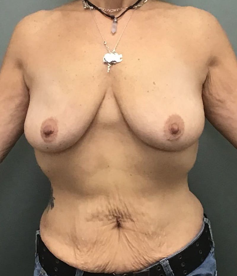 Breast Augmentation Before & After Gallery - Patient 109244 - Image 1