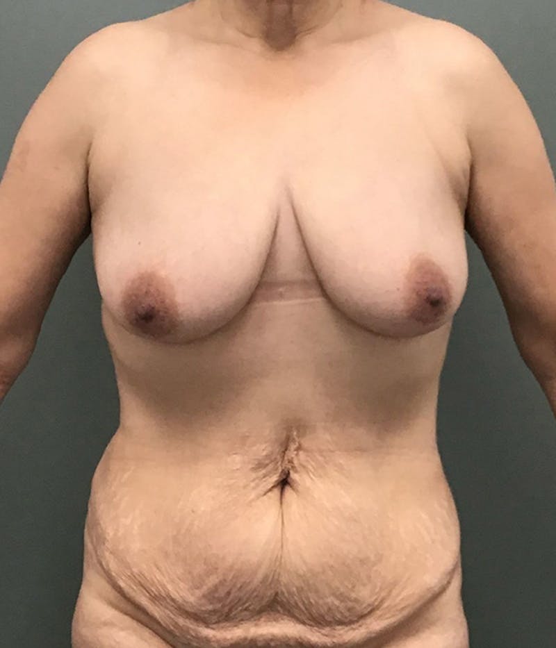 Breast Lift Before & After Gallery - Patient 256763 - Image 1