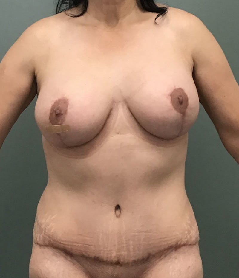 Breast Augmentation Before & After Gallery - Patient 207637 - Image 2