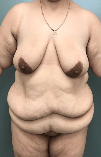 Body Contouring Before & After Gallery - Patient 132681 - Image 1