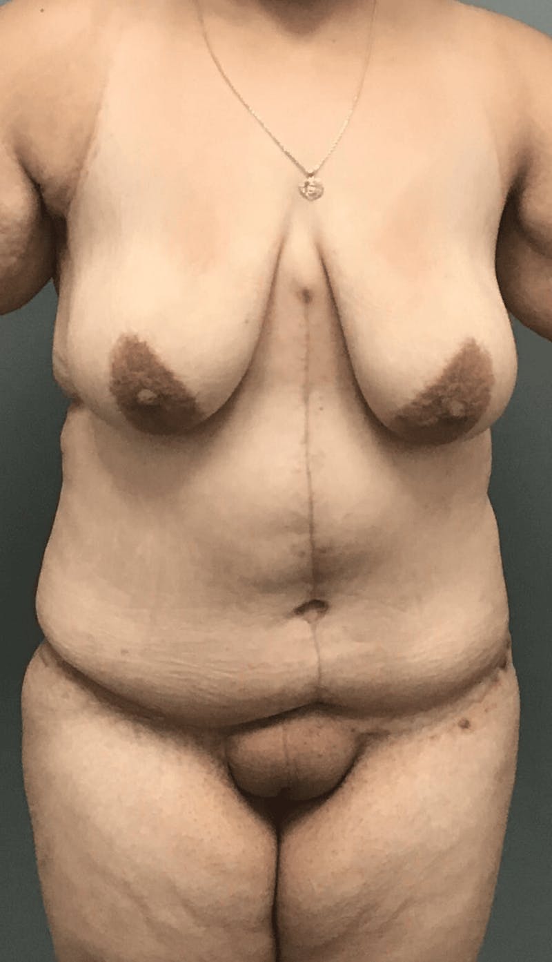 Body Contouring Before & After Gallery - Patient 132681 - Image 2