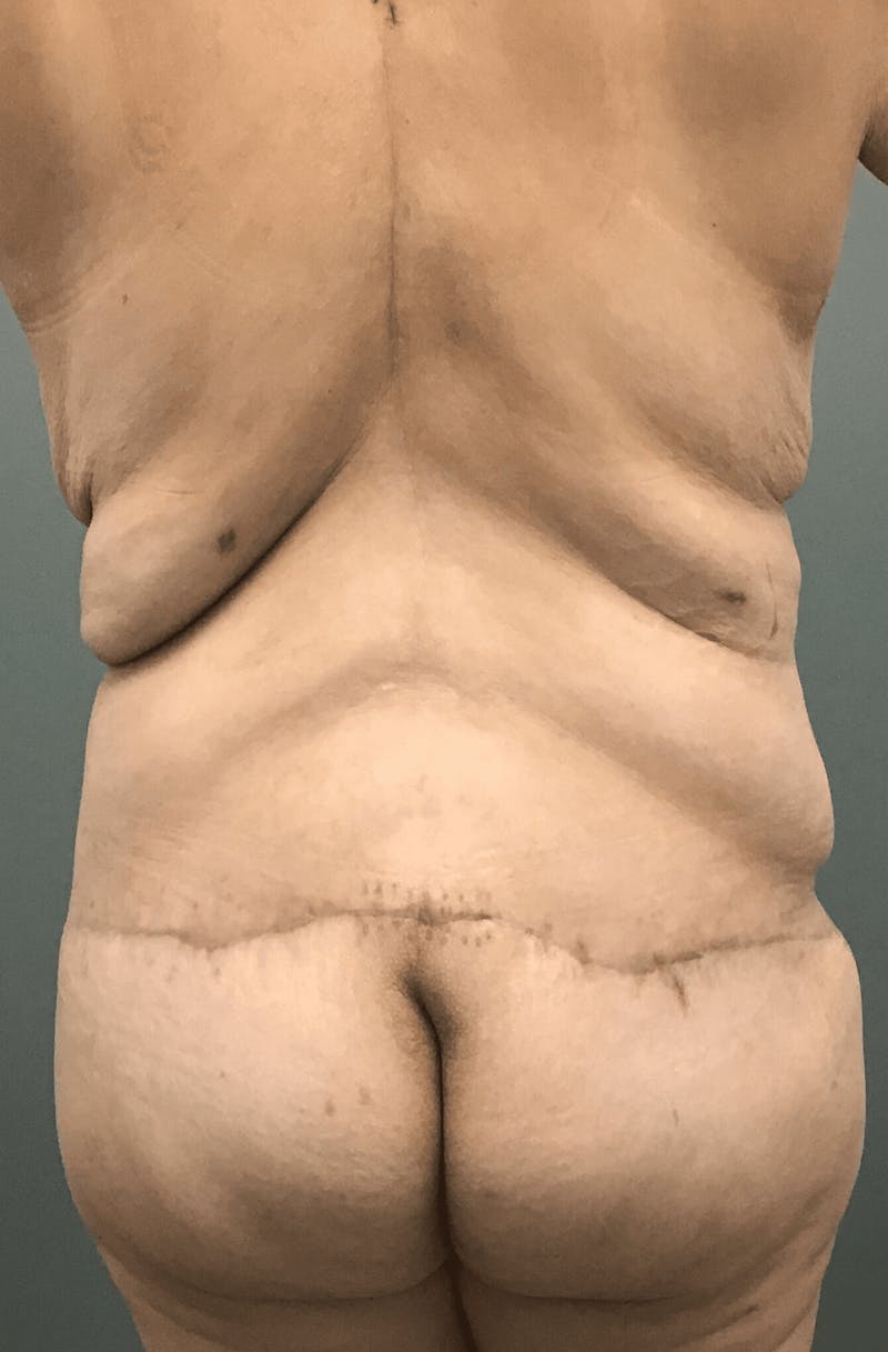 Body Contouring Before & After Gallery - Patient 132681 - Image 4