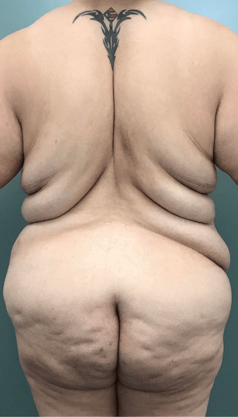 Body Contouring Before & After Gallery - Patient 132681 - Image 3