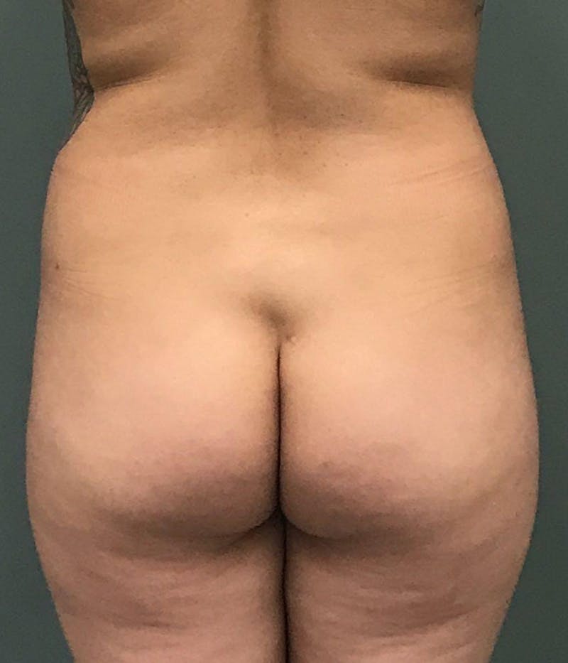 Brazilian Butt Lift Before & After Gallery - Patient 103401 - Image 1