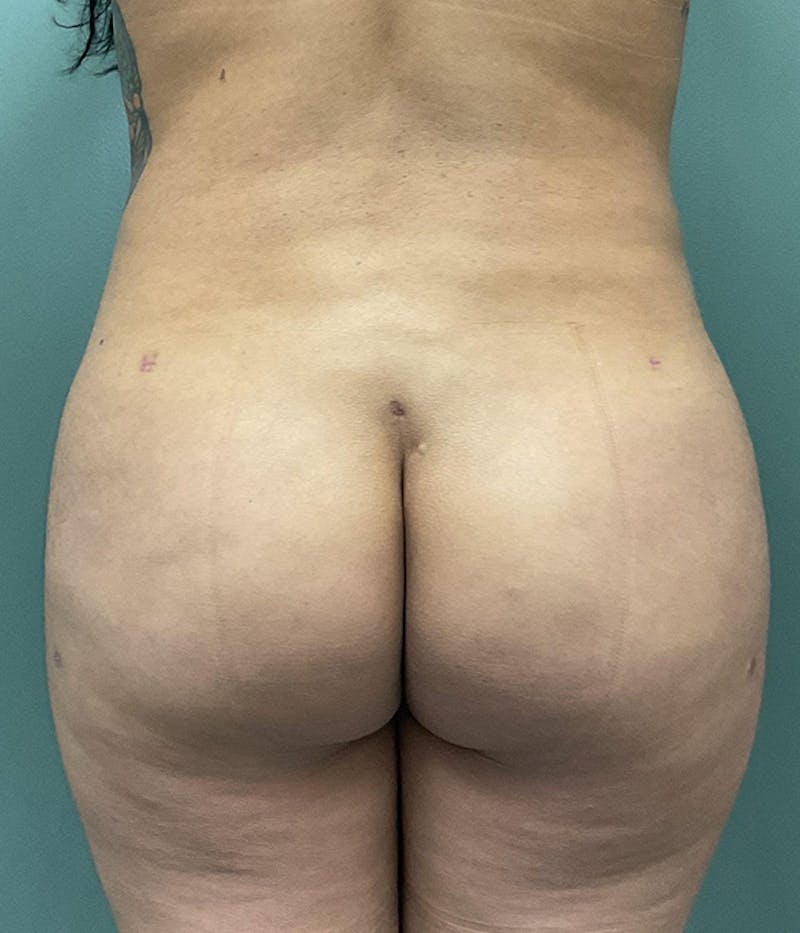 Brazilian Butt Lift Before & After Gallery - Patient 103401 - Image 2