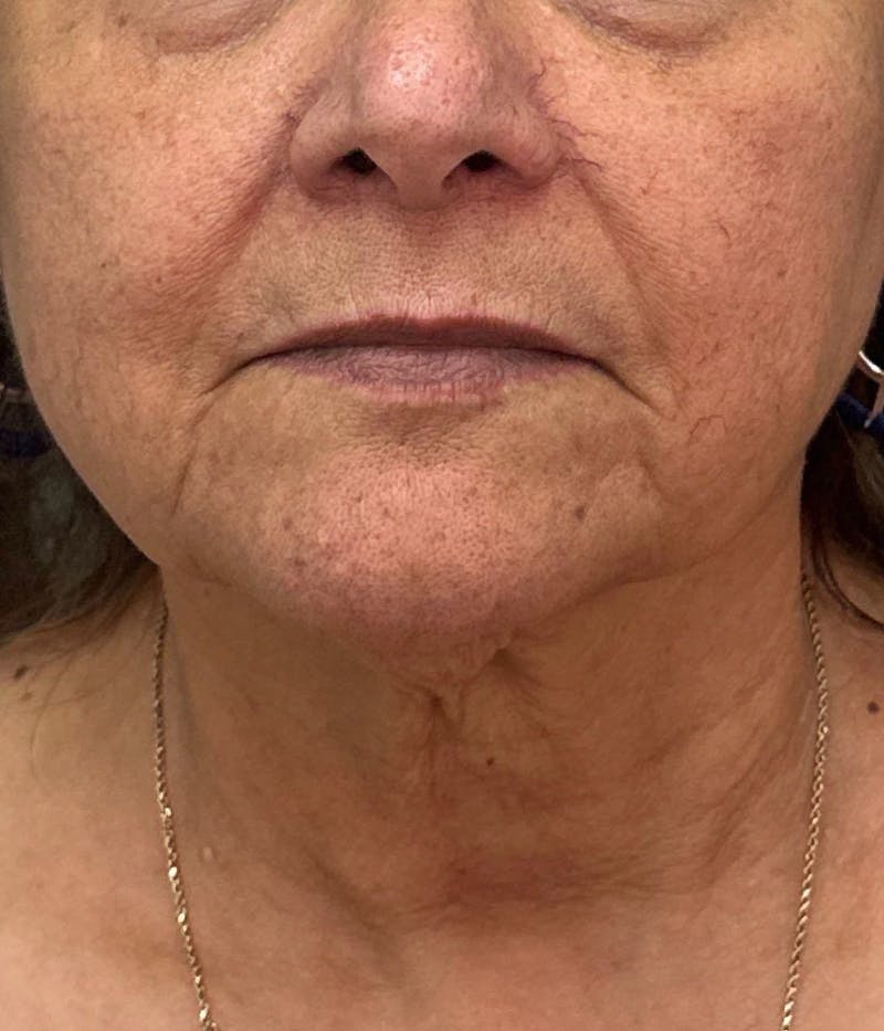 Dermal Fillers Before & After Gallery - Patient 360499 - Image 1