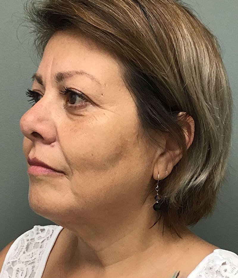 Facelift Before & After Gallery - Patient 205171 - Image 3