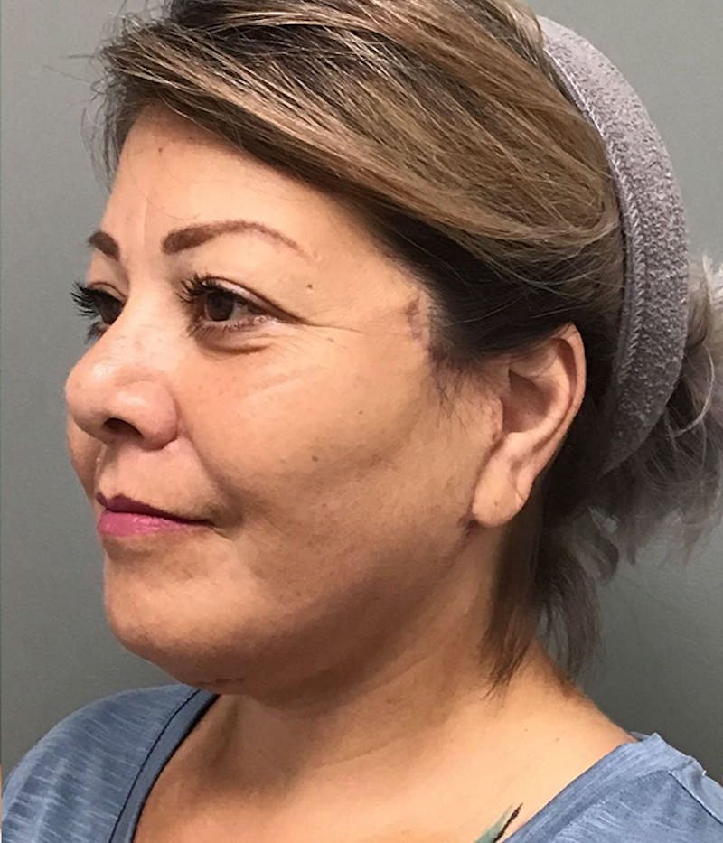Facelift Before & After Gallery - Patient 205171 - Image 4