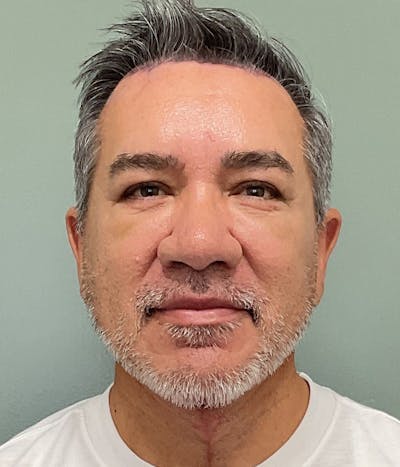 Facelift Before & After Gallery - Patient 365975 - Image 2