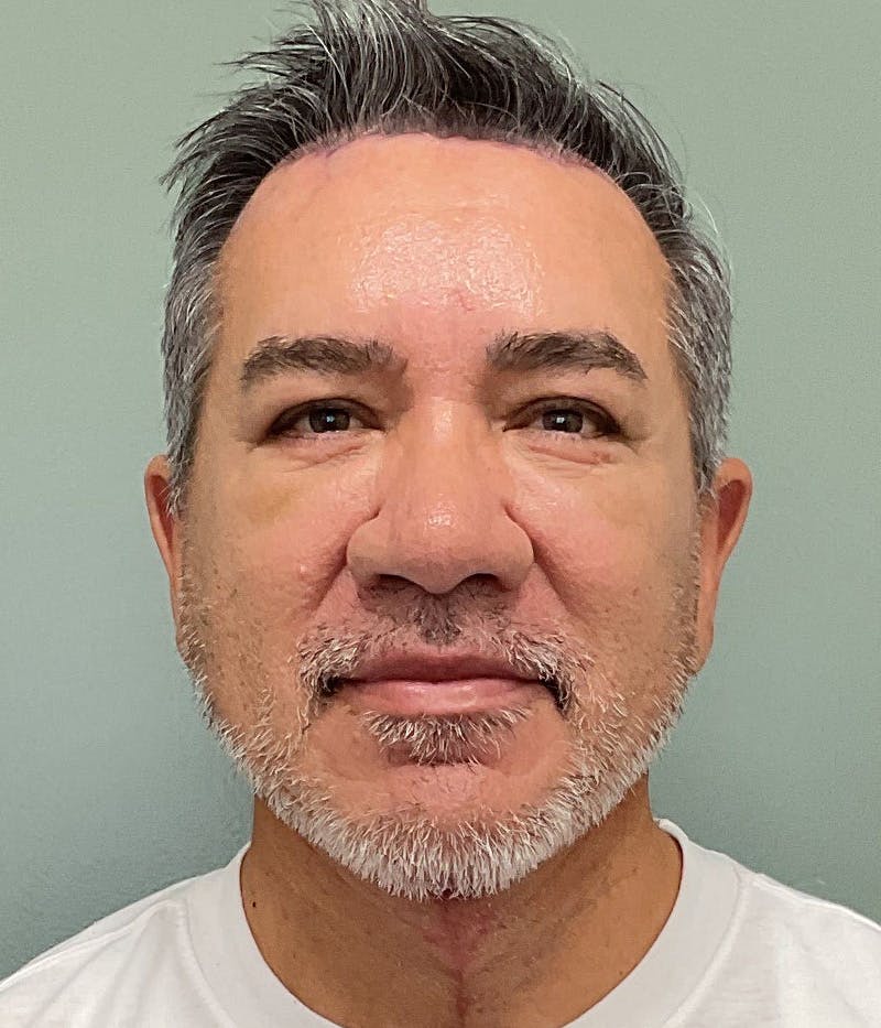 Facelift Before & After Gallery - Patient 365975 - Image 2