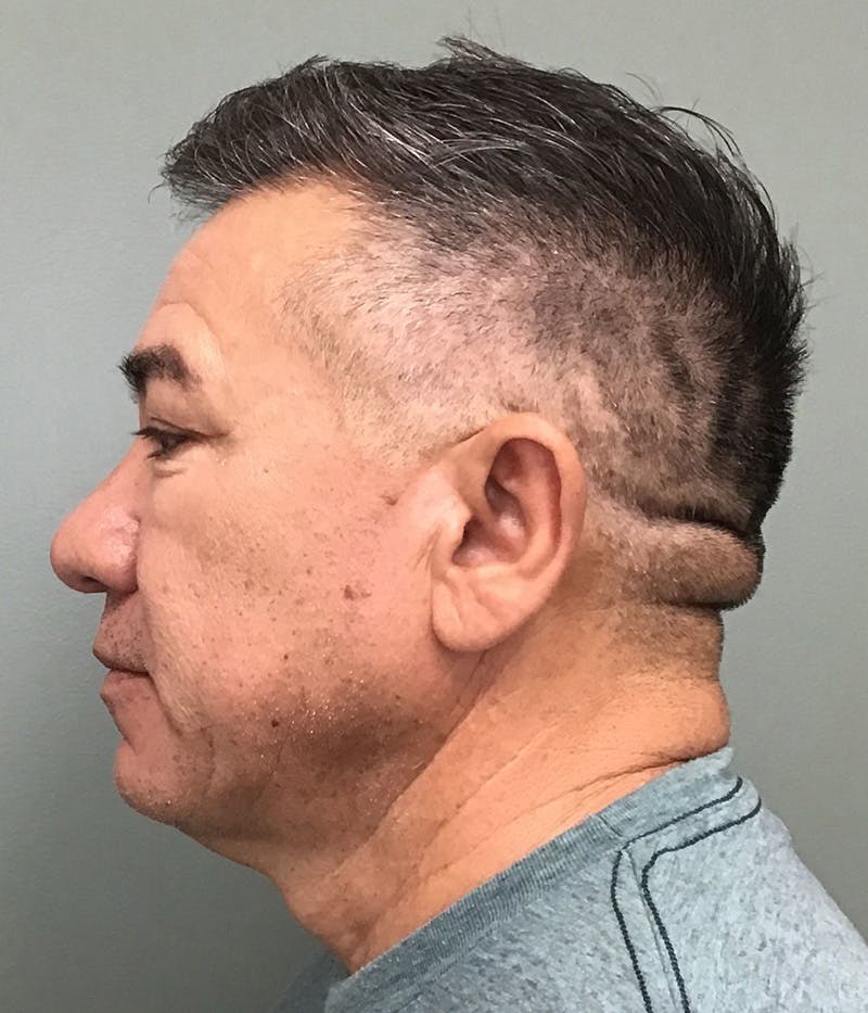 Facelift Before & After Gallery - Patient 365975 - Image 5