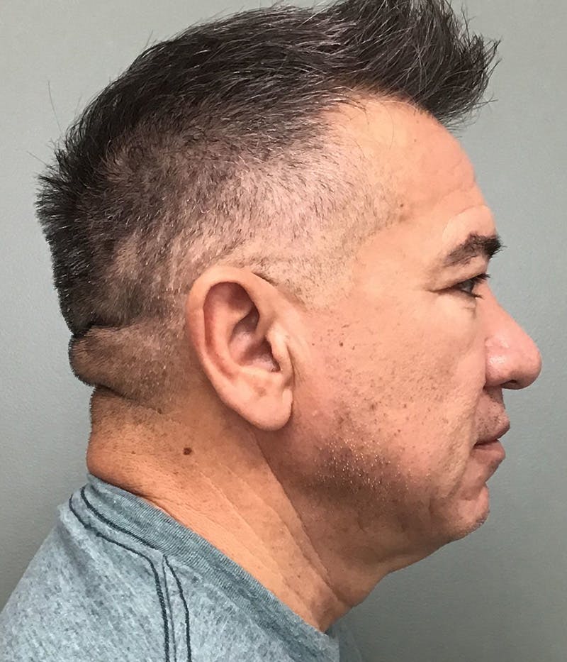 Facelift Before & After Gallery - Patient 365975 - Image 3