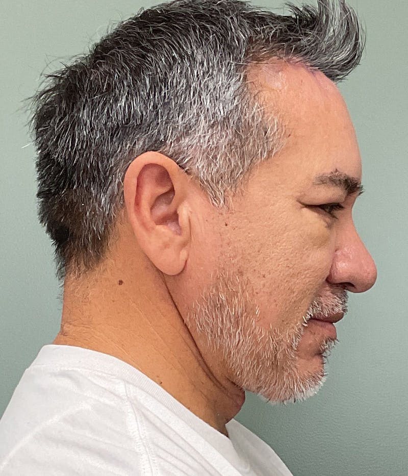 Facelift Before & After Gallery - Patient 365975 - Image 4