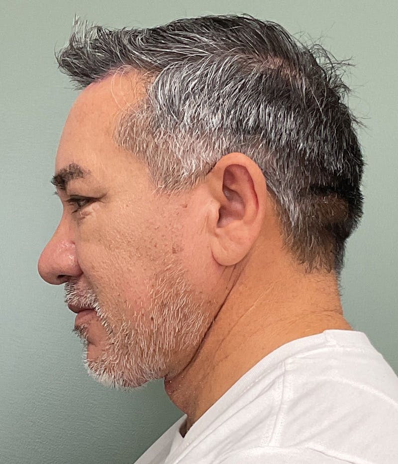 Facelift Before & After Gallery - Patient 365975 - Image 6
