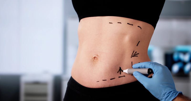 Female Surgeon Performing Liposuction Surgery