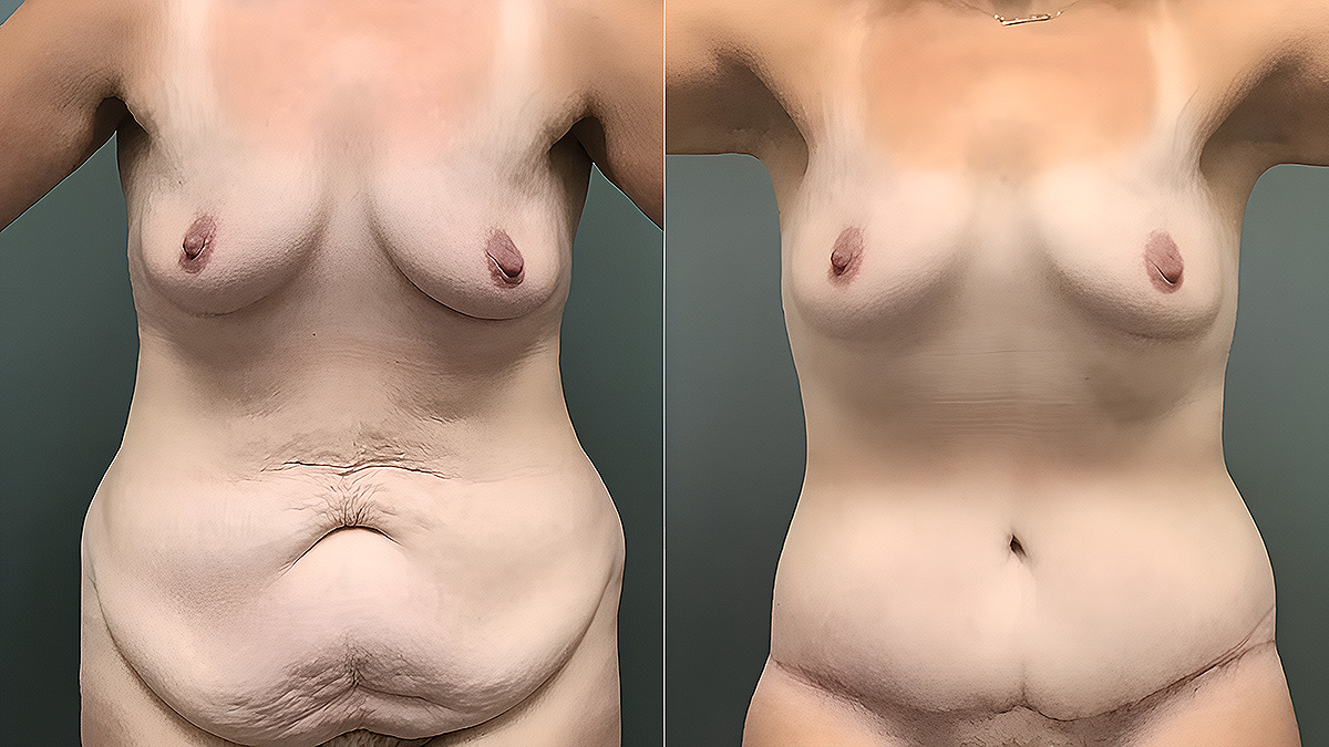 Before and After Tummy Tuck Photos - 34-year-old female. 3 Months Post-Op