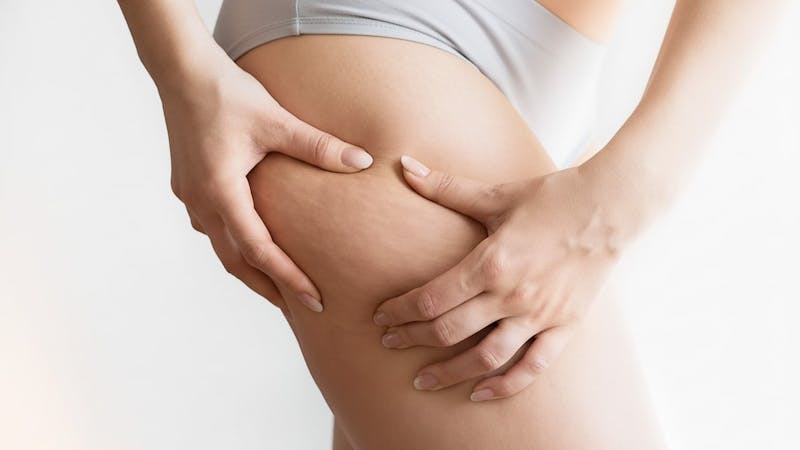 Can You Get Rid of Cellulite - Dr Baumholtz Blog Image