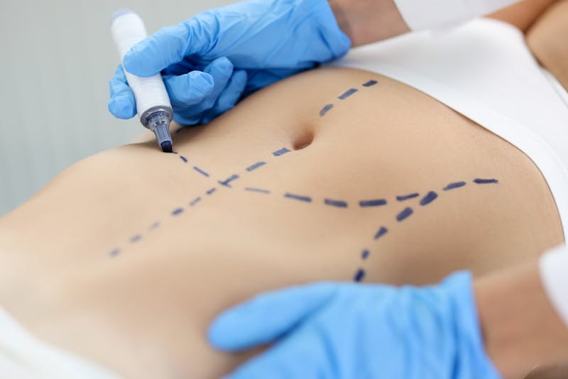 Doctor drawing preoperative marking on patient abdomen closeup.