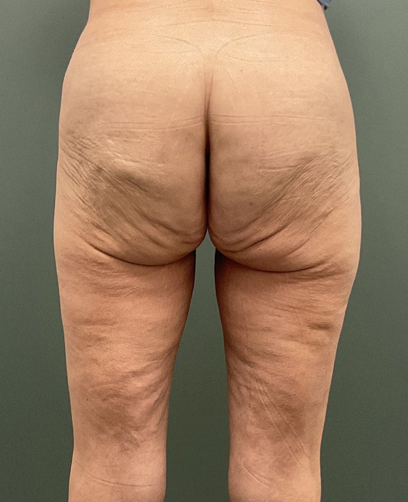 Thigh Lift Before & After Gallery - Patient 207486 - Image 3