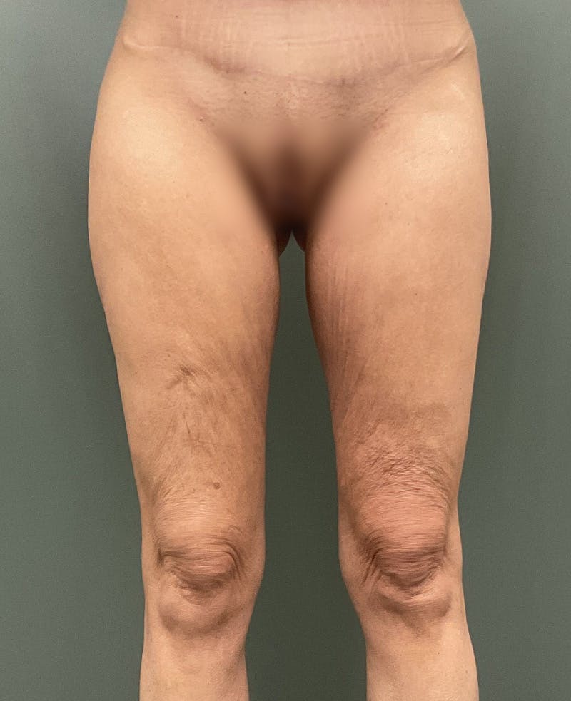 Thigh Lift Before & After Gallery - Patient 207486 - Image 1