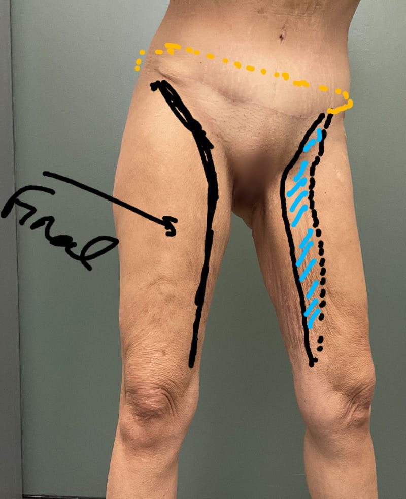 Thigh Lift Before & After Gallery - Patient 207486 - Image 5