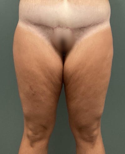 Thigh Lift Before & After Gallery - Patient 498854 - Image 1