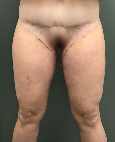 Thigh Lift Before & After Gallery - Patient 498854 - Image 2