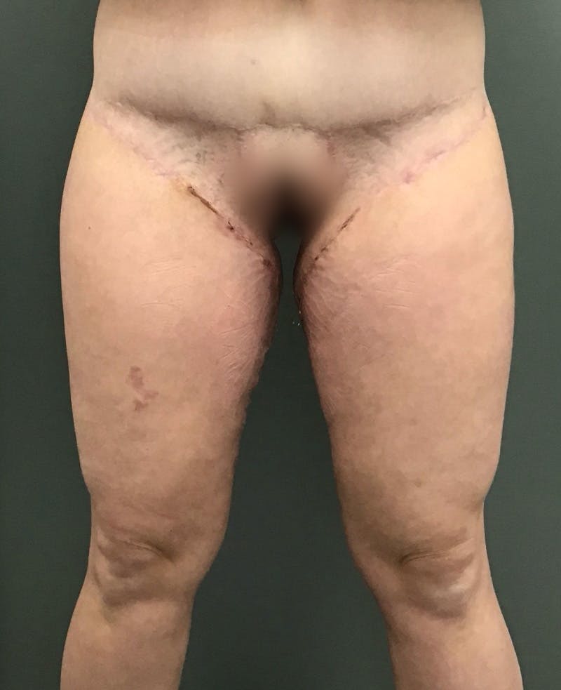 Thigh Lift Before & After Gallery - Patient 498854 - Image 2