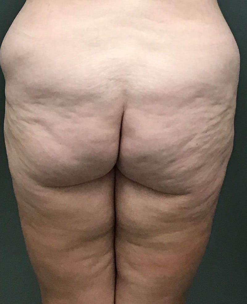 Thigh Lift Before & After Gallery - Patient 498854 - Image 3