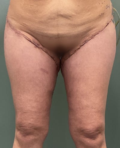 Thigh Lift Before & After Gallery - Patient 883953 - Image 2