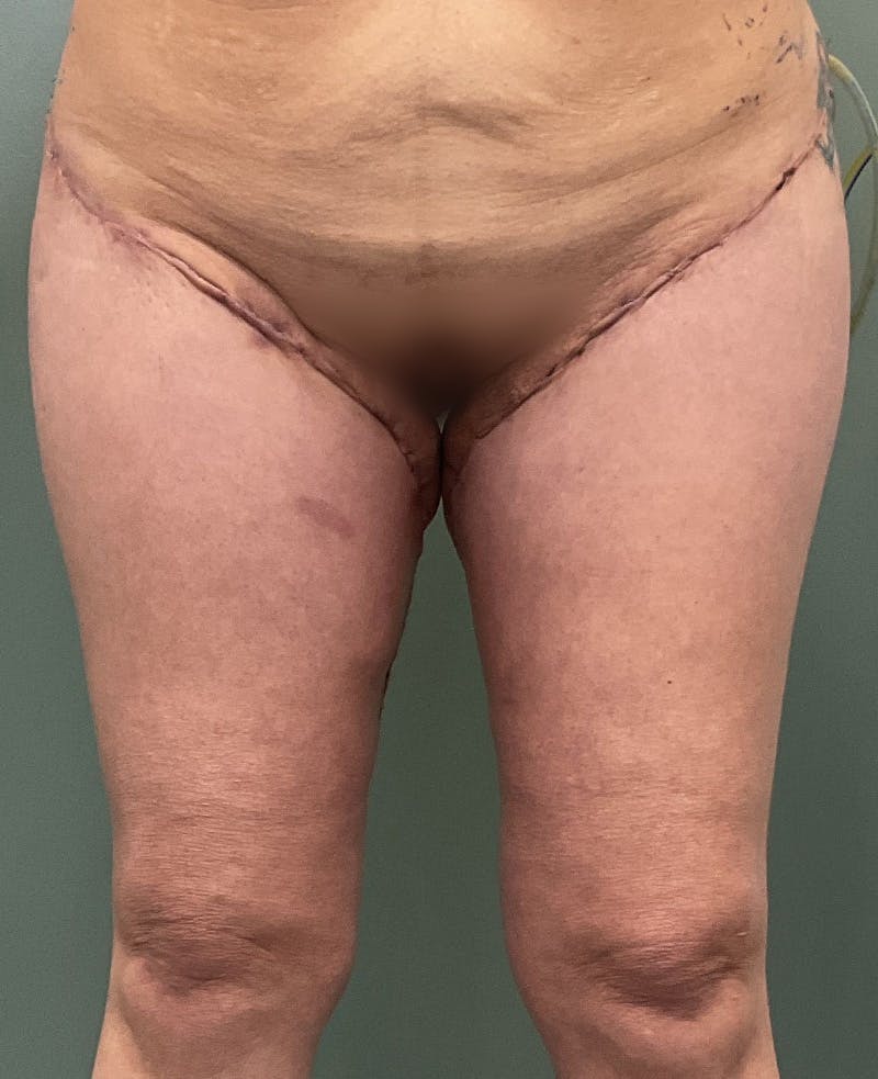 Thigh Lift Before & After Gallery - Patient 883953 - Image 2