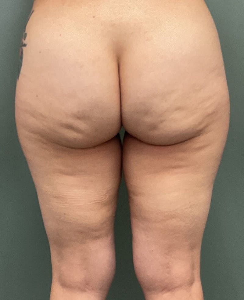 Thigh Lift Before & After Gallery - Patient 883953 - Image 3