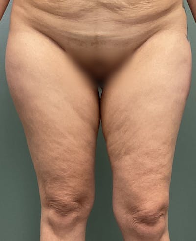 Thigh Lift Before & After Gallery - Patient 883953 - Image 1