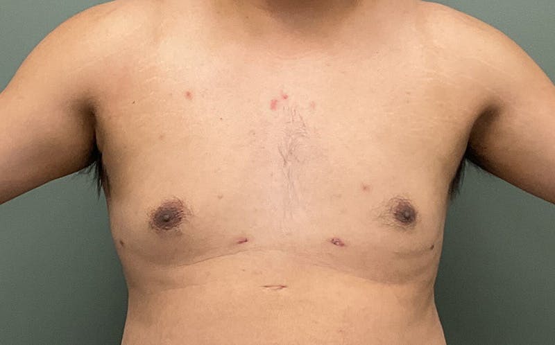 Male Breast Reduction Before & After Gallery - Patient 139686 - Image 2
