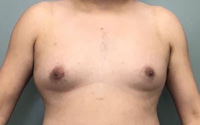 Male Breast Reduction Before & After Gallery - Patient 139686 - Image 1