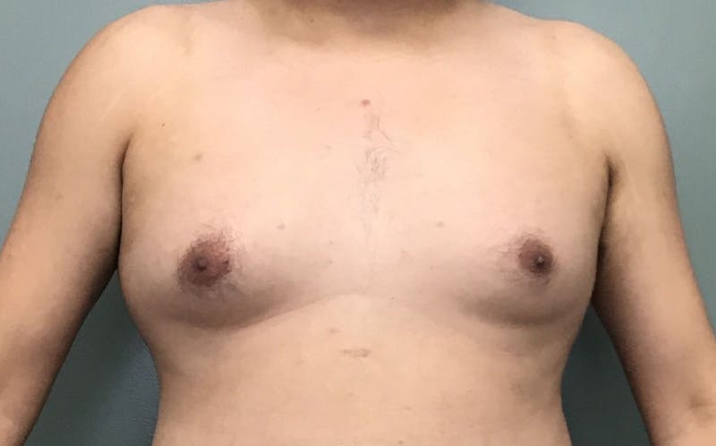 Male Breast Reduction Before & After Gallery - Patient 139686 - Image 1