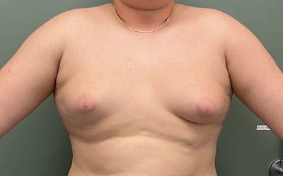 Male Breast Reduction Before & After Gallery - Patient 197117 - Image 1