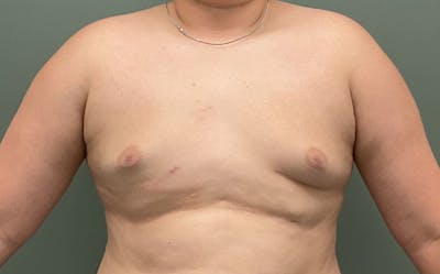Male Breast Reduction Before & After Gallery - Patient 197117 - Image 2