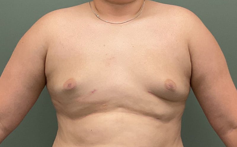 Male Breast Reduction Before & After Gallery - Patient 197117 - Image 2