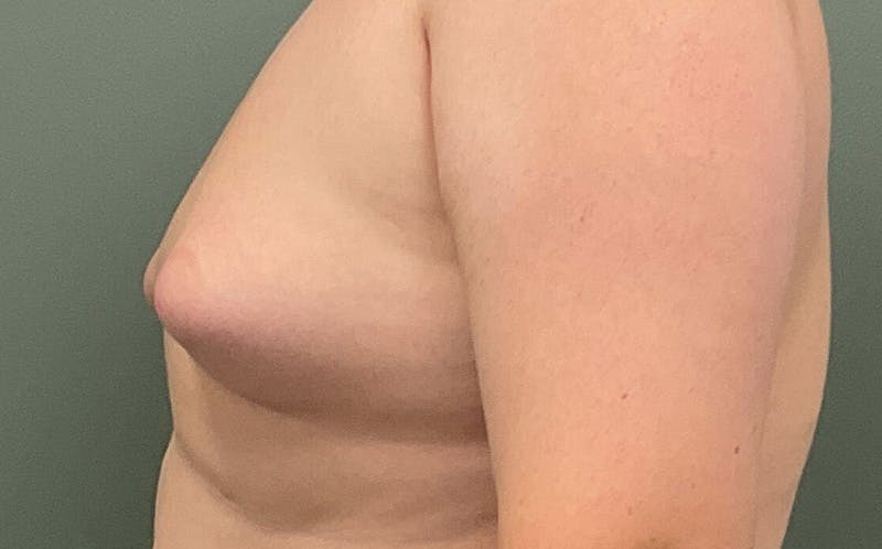 Male Breast Reduction Before & After Gallery - Patient 197117 - Image 3