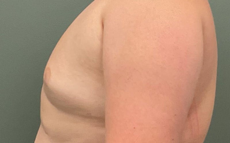 Male Breast Reduction Before & After Gallery - Patient 197117 - Image 4