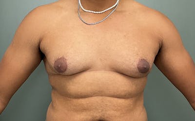 Male Breast Reduction Before & After Gallery - Patient 784376 - Image 1