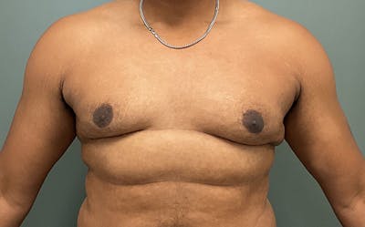 Male Breast Reduction Before & After Gallery - Patient 784376 - Image 2