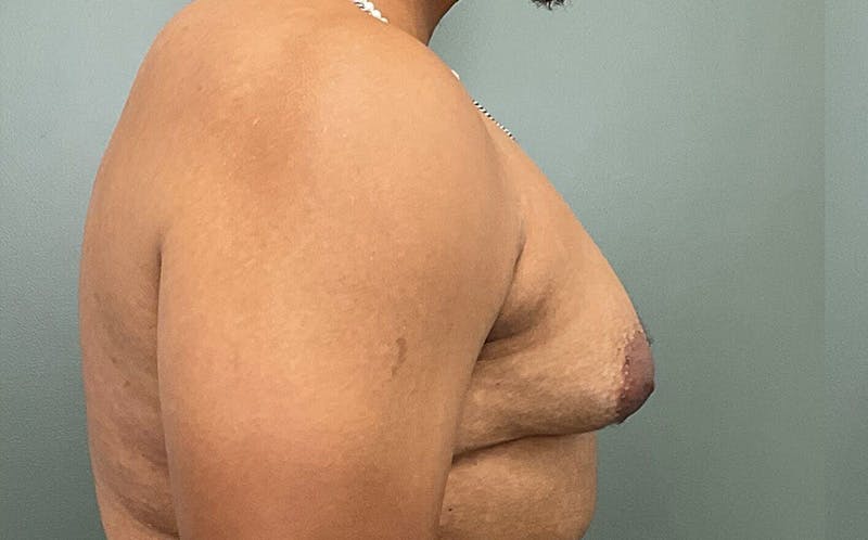 Male Breast Reduction Before & After Gallery - Patient 784376 - Image 3